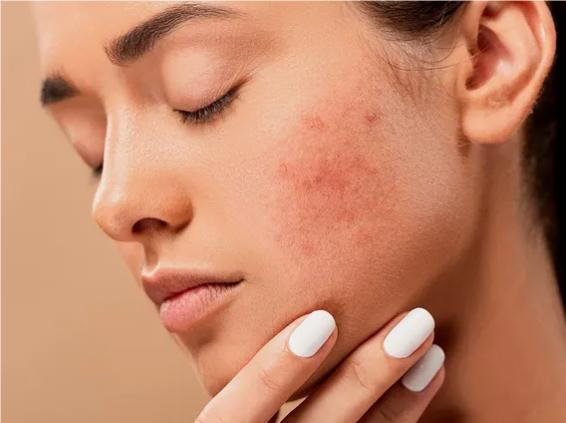 如何治愈皮肤敏感损伤